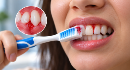 Bleeding gums while brushing teeth
